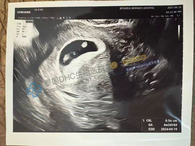 泰國DHC好孕檔案0827：從4次流產(chǎn)到聽見心跳