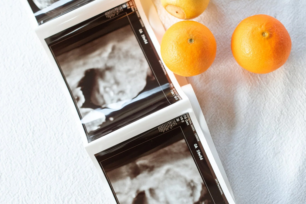 結(jié)婚三年沒懷孕正常嗎？多年未孕的原因