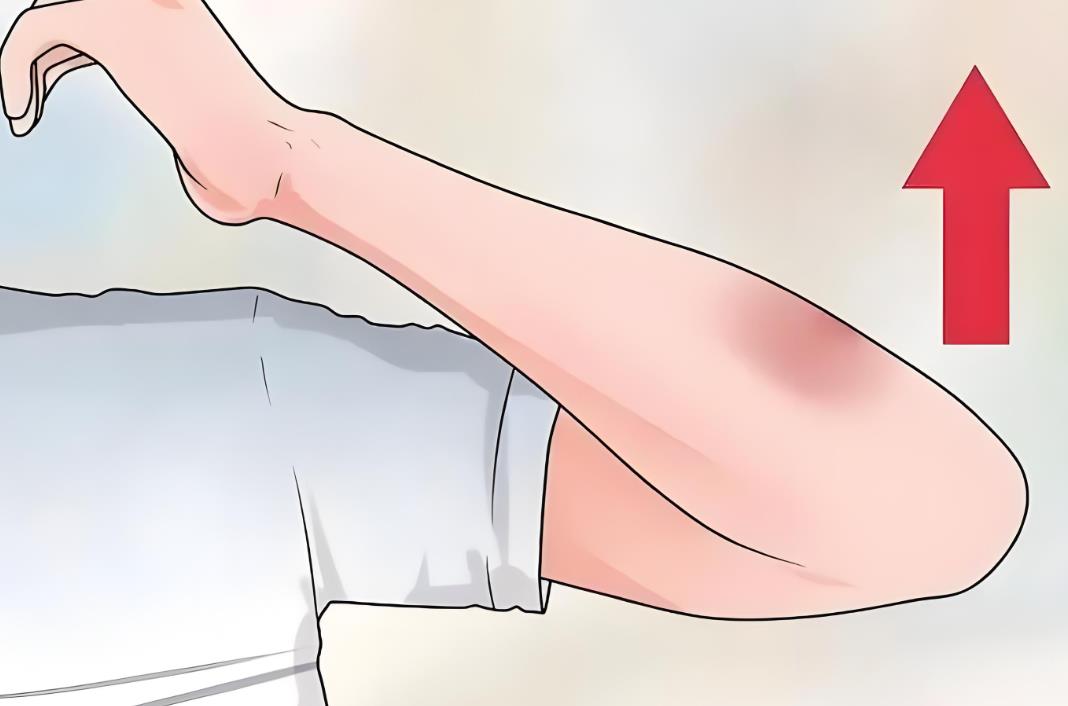 試管打針淤青,試管打針促排期間注意事項(xiàng)