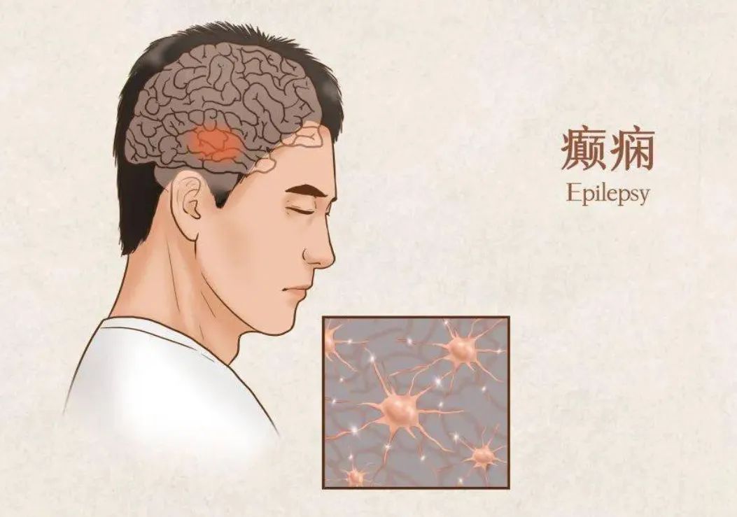 癲癇 癲癇