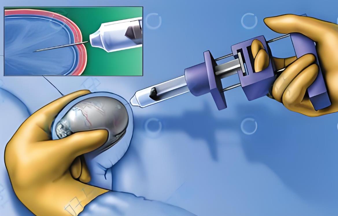 試管取精 試管取精