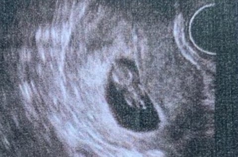 陰超可以檢查出哪些婦科疾??？陰超檢查疾病一覽