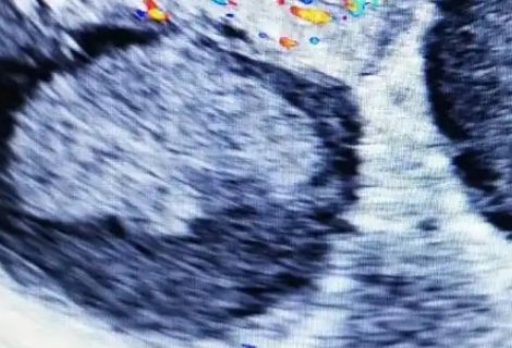 陰超最早幾天查到孕囊？懷孕跡象時間一覽